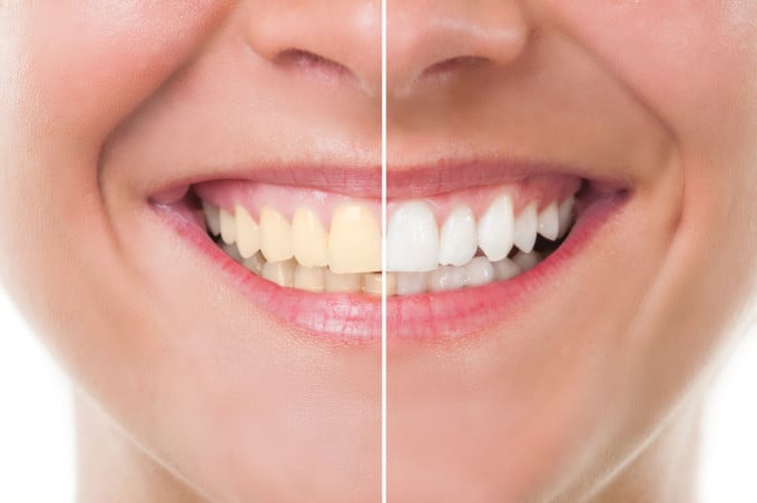 before and after of mouth with brown then white teeth